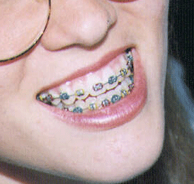 Removing Braces